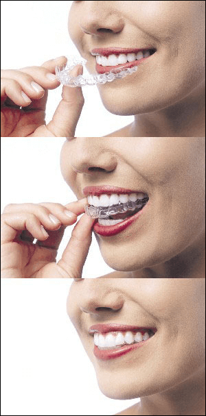 Three images stacked vertically showing how to snap invisalign aligners in place.